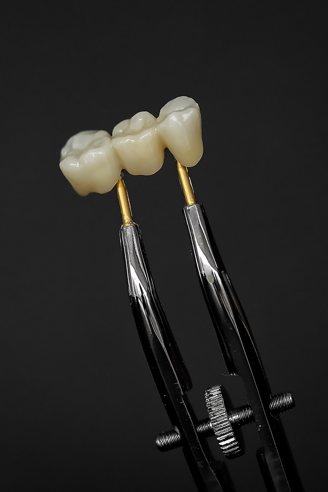 Affordable solution to replacing missing teeth with Dental bridges