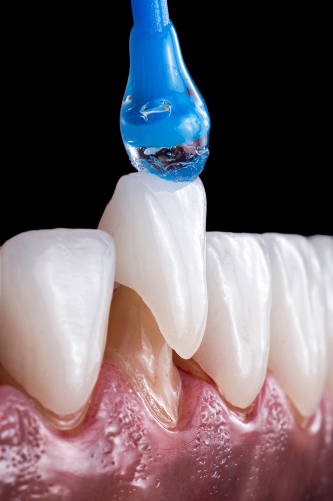 Zirconia dental crown restoration at Toluca Advanced Dentistry in North Hollywood