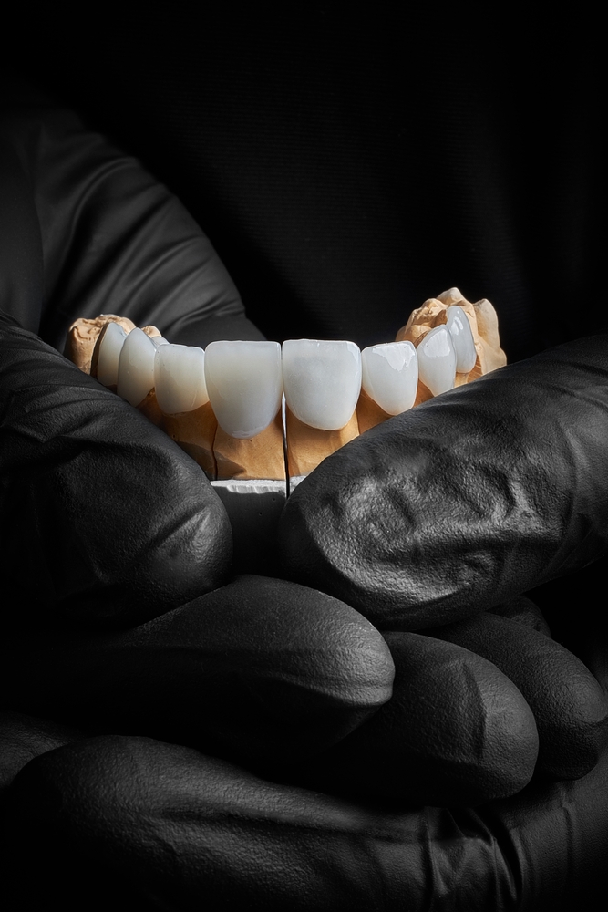 porcelain veneers preview #2