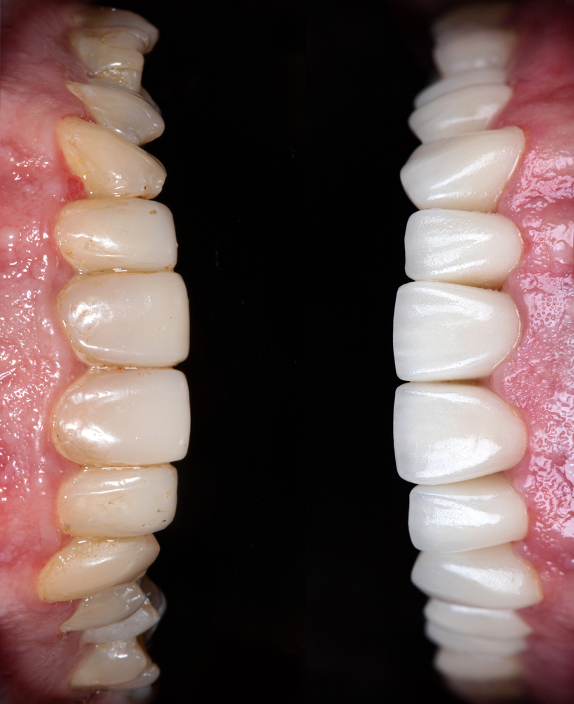 teeth whitening before and after