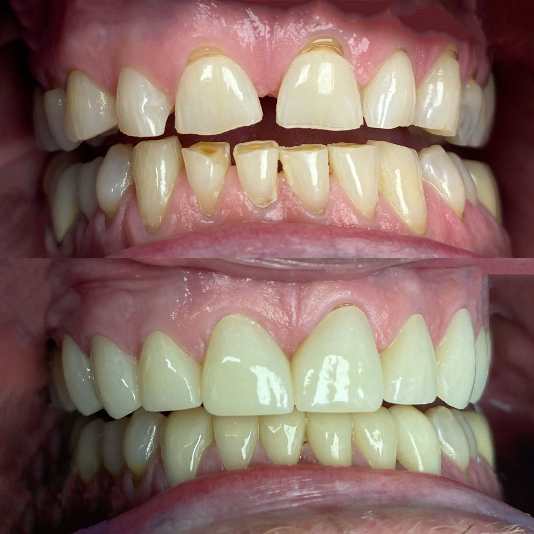 Before full mouth porcelain veneers North Hollywood