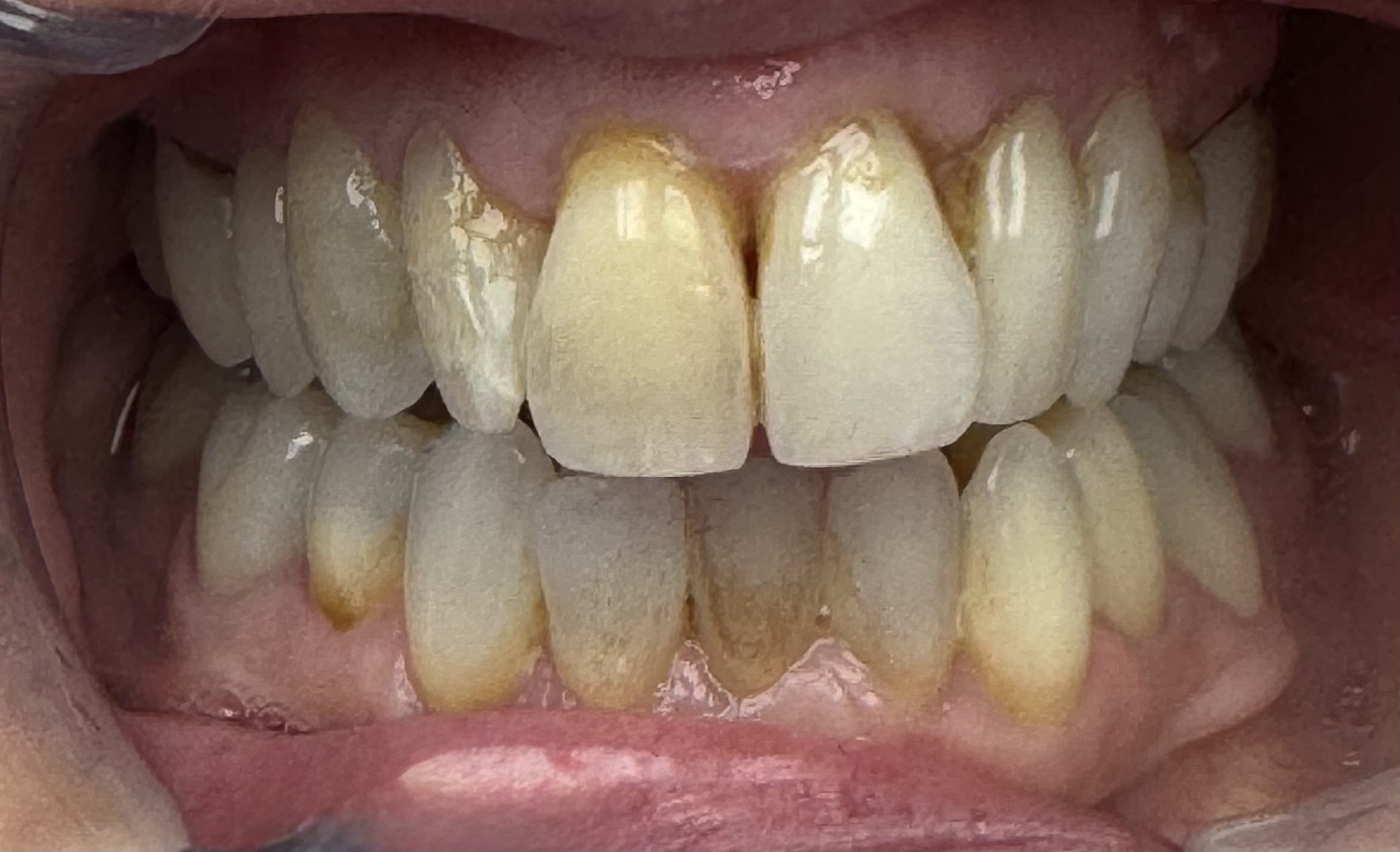 Patient smile before porcelain veneers at Toluca Advanced Dentistry, North Hollywood