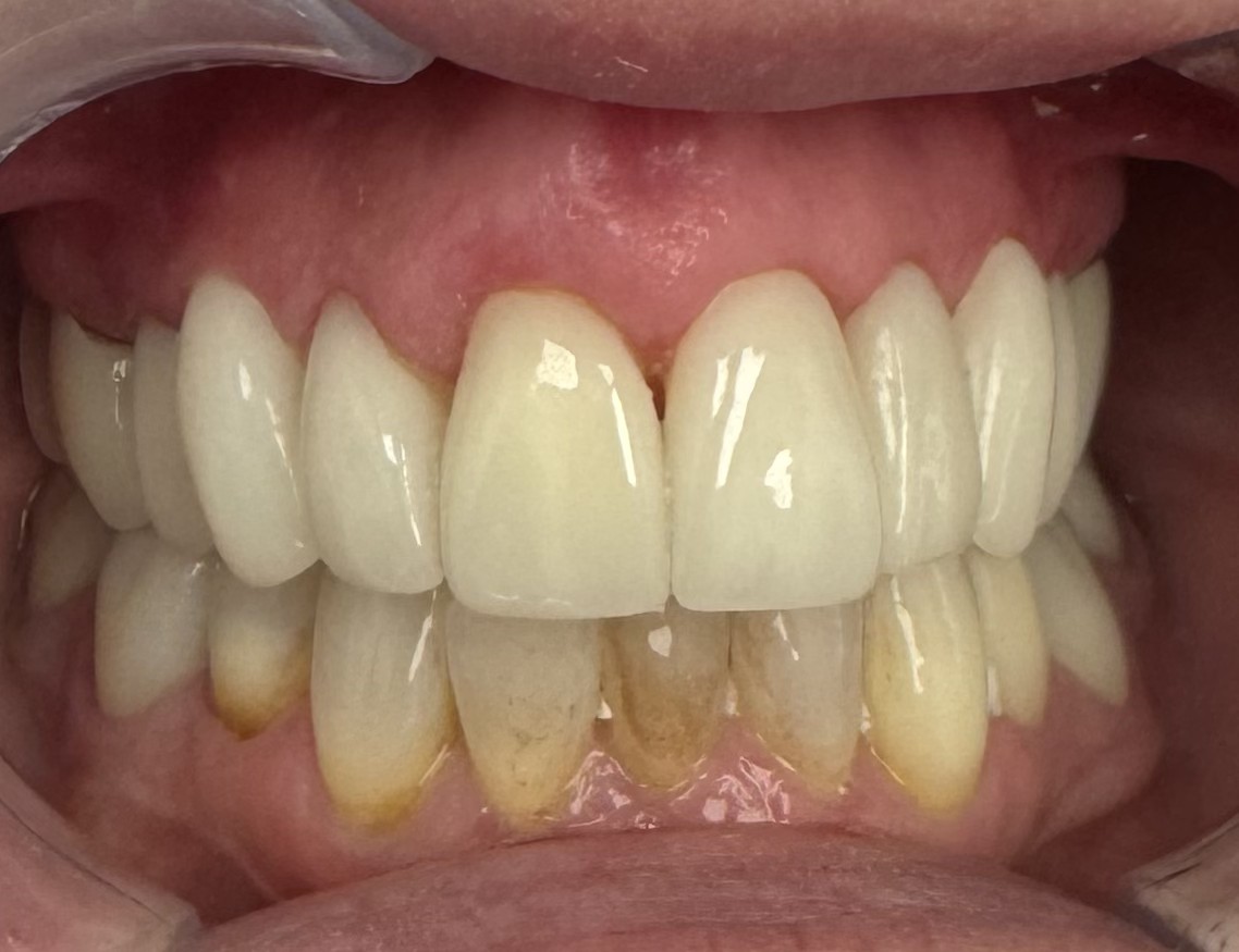 Patient smile after porcelain veneers at Toluca Advanced Dentistry, North Hollywood