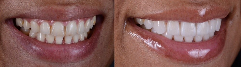 Example of veneer results for stained teeth that won't whiten