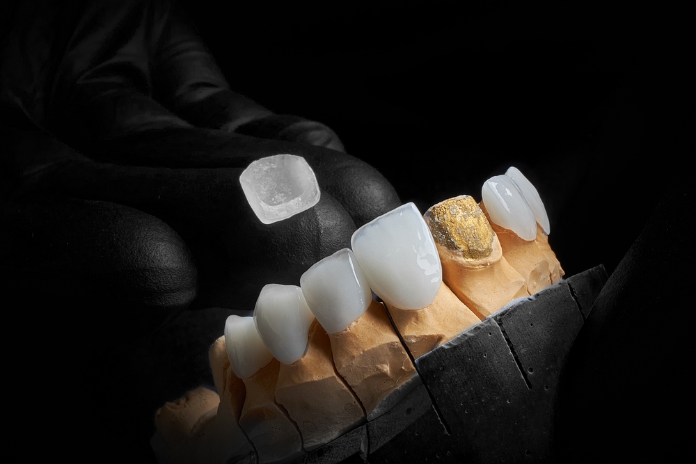 Full smile makeover porcelain veneers North Hollywood