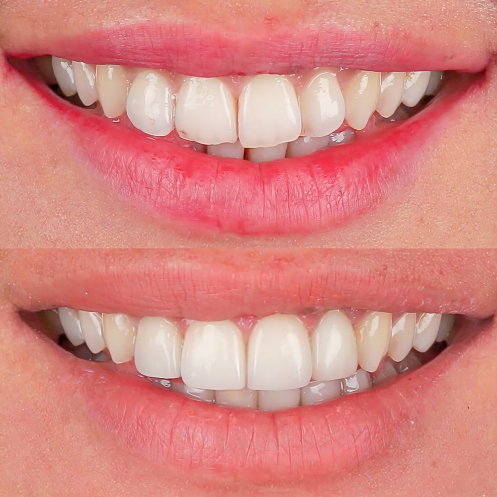 Invisalign with bonding before and after Studio City North Hollywood