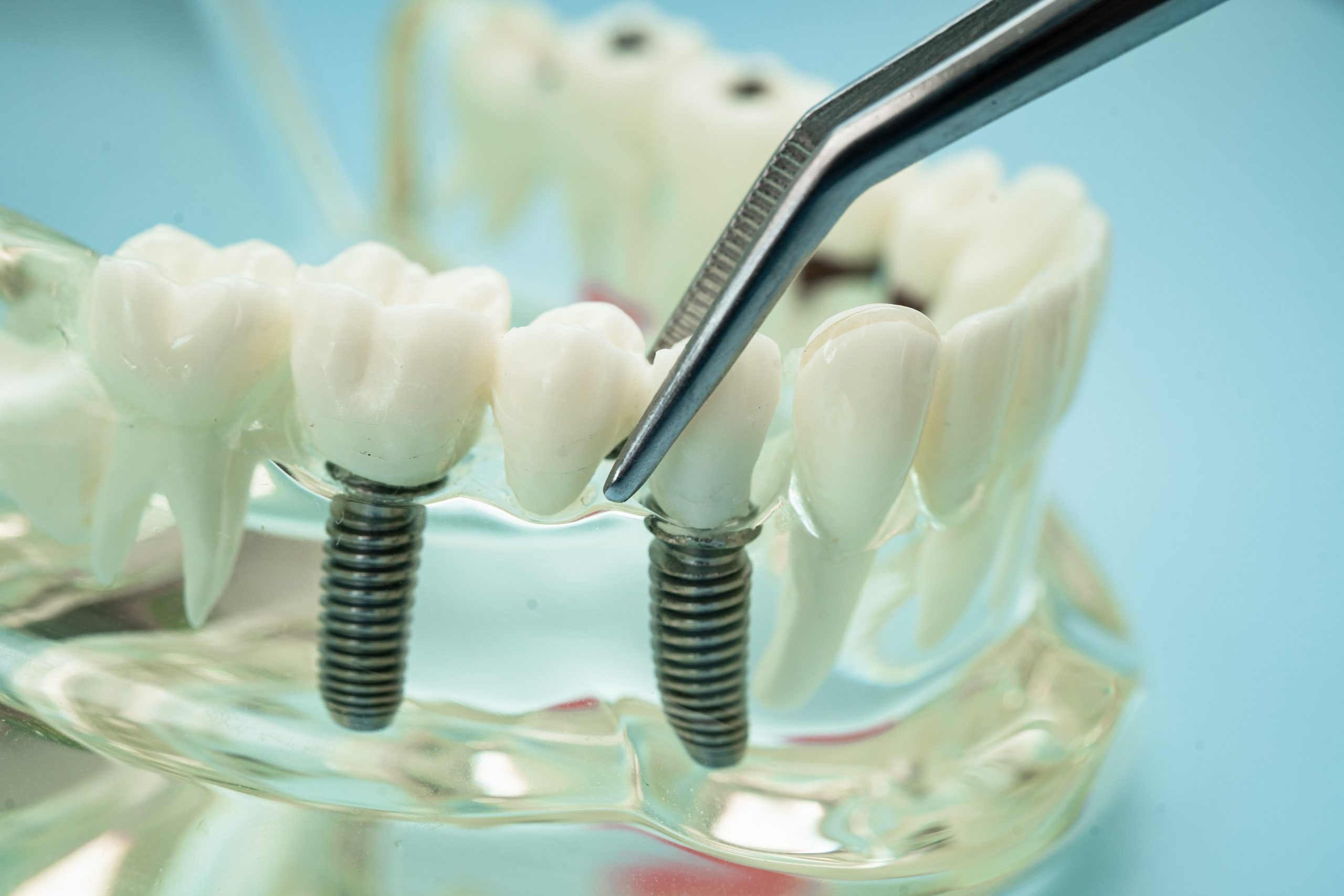 Dental implant bridge restoration North Hollywood Toluca Lake