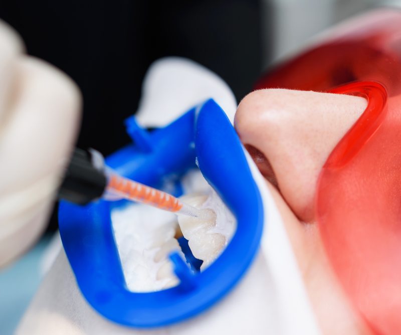 The Truth About TikTok Teeth Whitening Trend